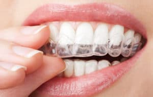 wear your retainer