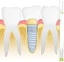Why Shall I Choose An Implant To Replace My Missing Tooth