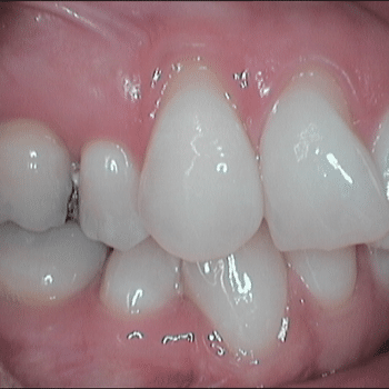 gum recession and crooked teeth