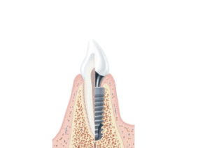 Advantage Of Dental Implant