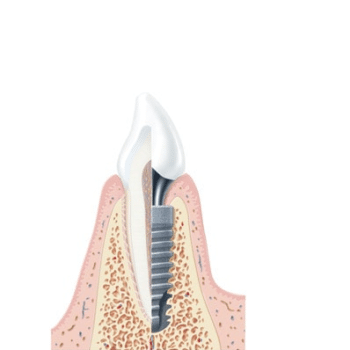 Advantage Of Dental Implant