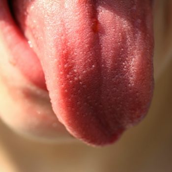 hairy tongue