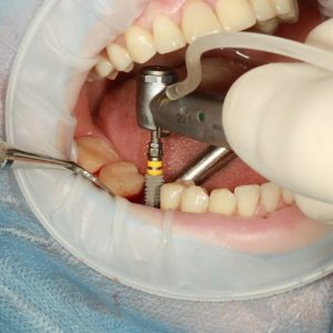 Immediate Dental Implantation