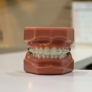 type of braces