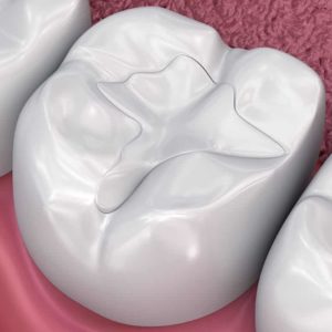 white tooth fillings