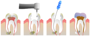 dead tooth root canal
