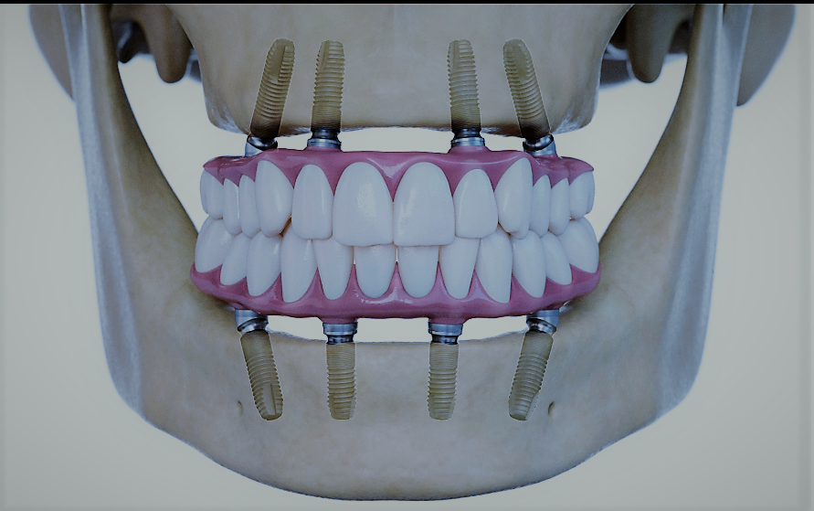 modern tooth replacement system